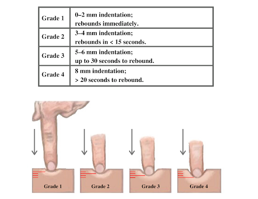 Illustration showing the grading of edema with a finger pressing into skin