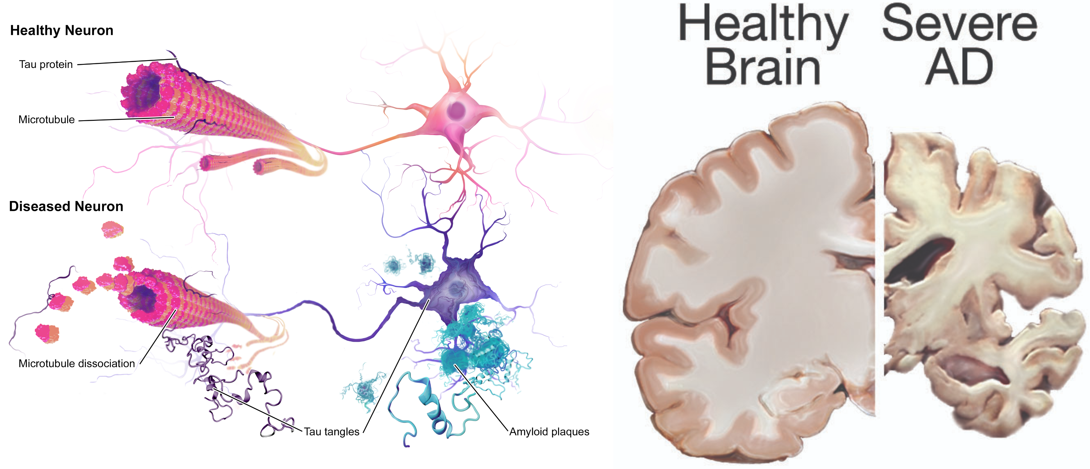 Images showing brain and neurons affected by Alzheimer’s Disease, with labels
