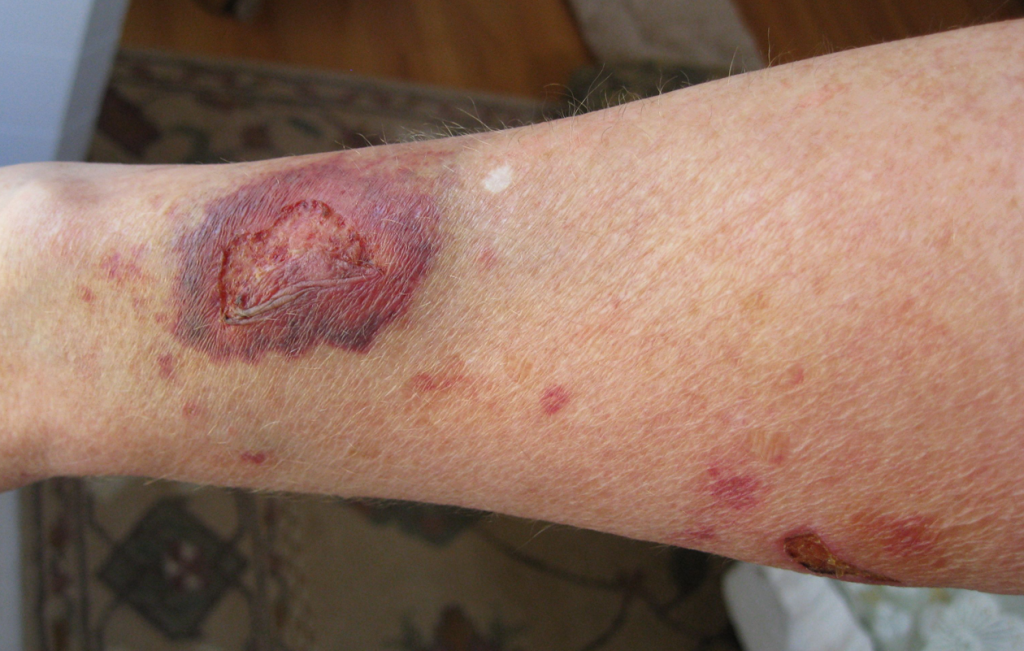 Photo showing Secondary Intention Wound Healing