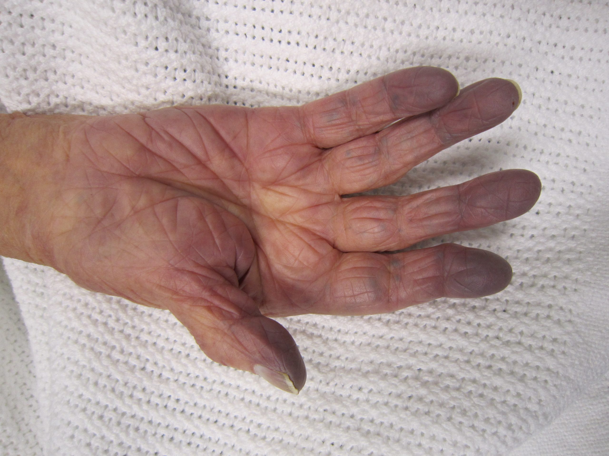 Photo showing hand with cyanosis on fingertips