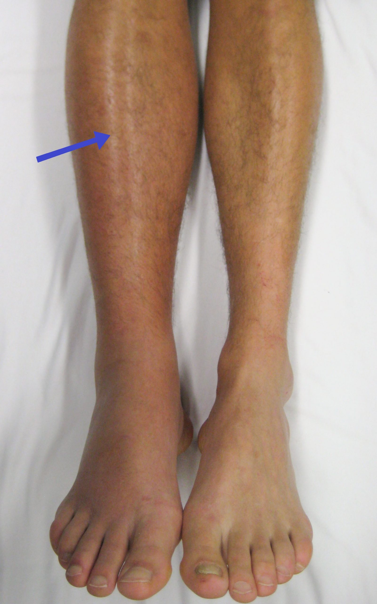 Image showing Deep Vein Thrombosis (DVT) with an arrow pointing to leg affected