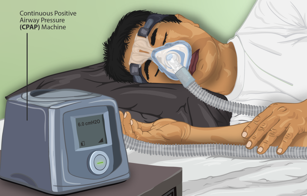 Illustration showing CPAP in use