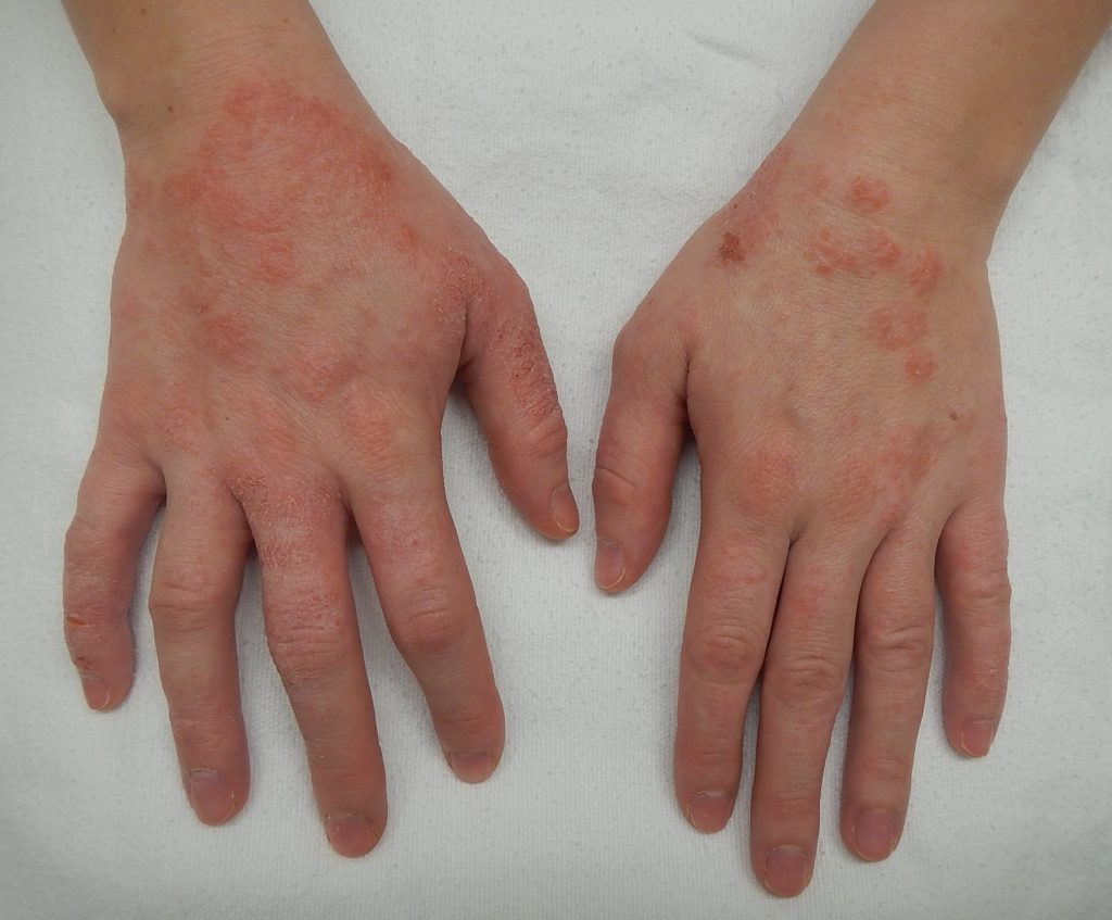 Image showing contact dermatitis on the hands