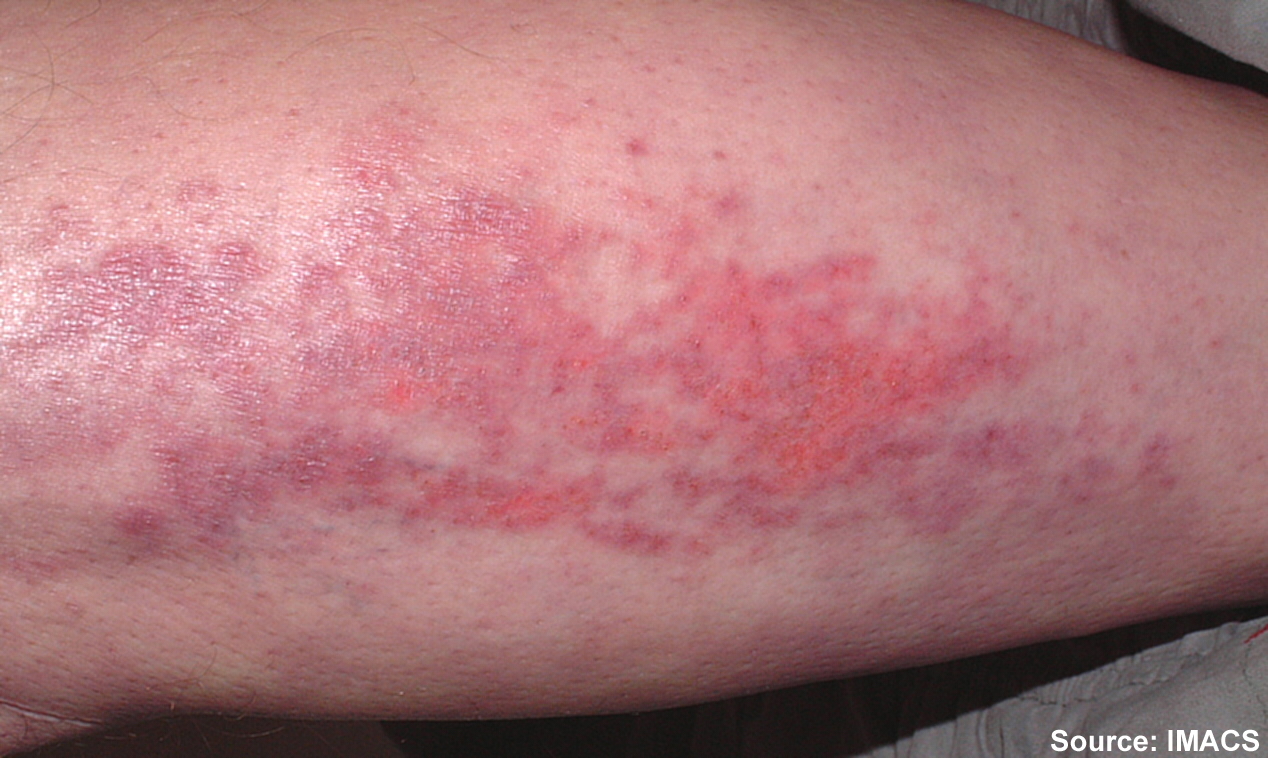 Photo showing excoriation