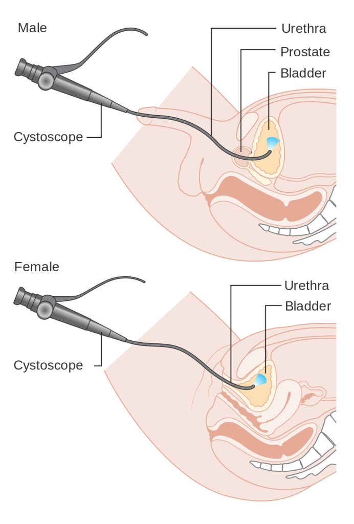 Illustration showing cystoscopy on both a male and a female