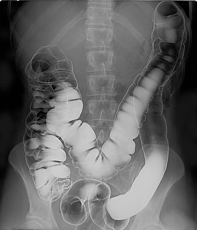 Image showing x-ray of barium enema results