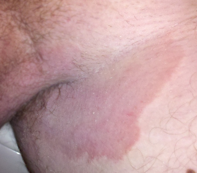 Photo showing Fungal Infection in the Groin