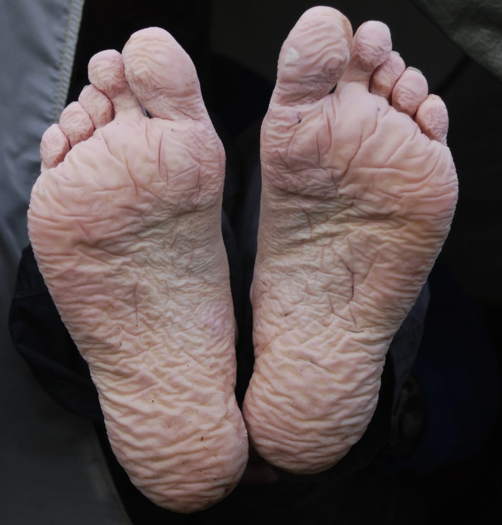 Photo showing maceration on feet