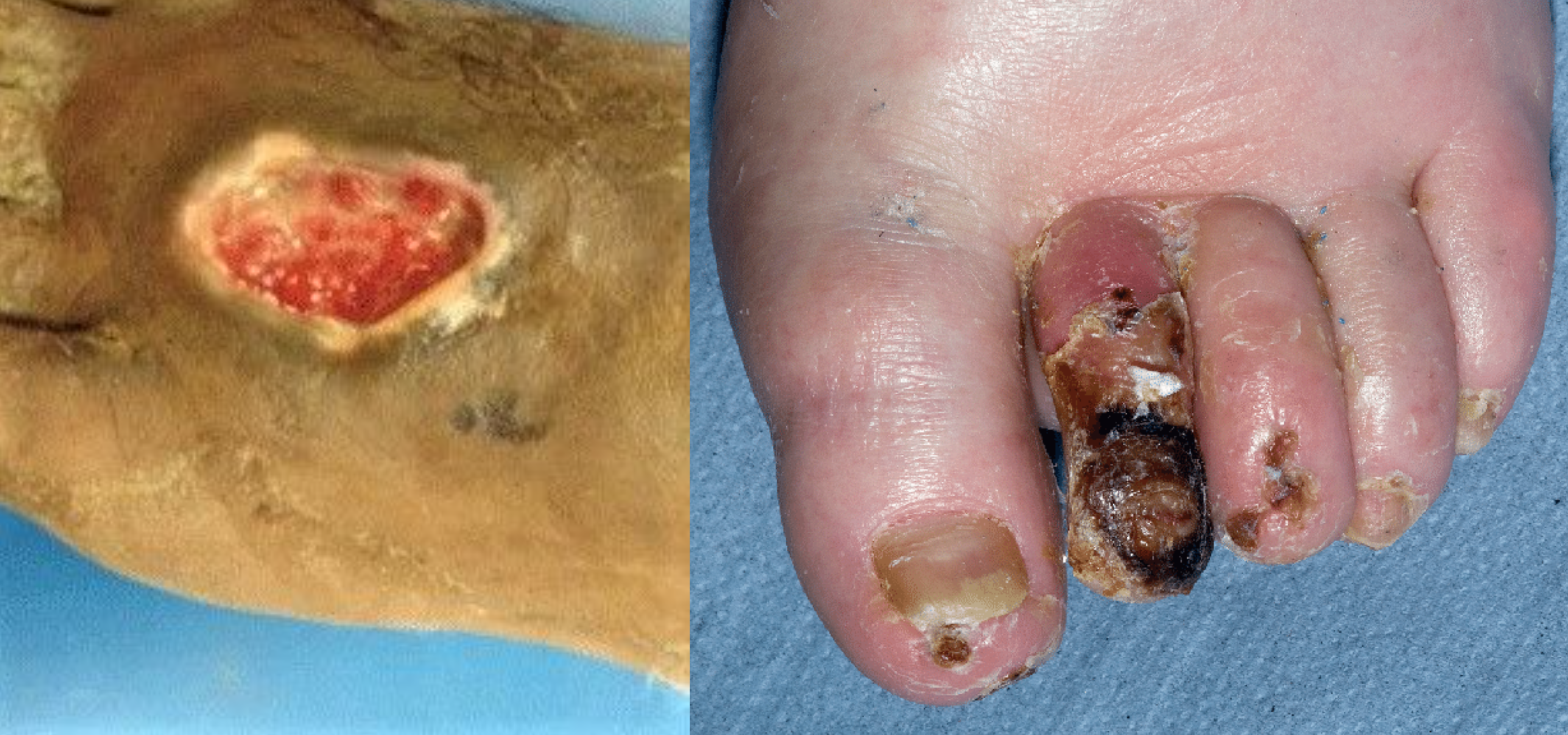Photos showing Arterial Insufficiency Ulcer and Necrotic Toes